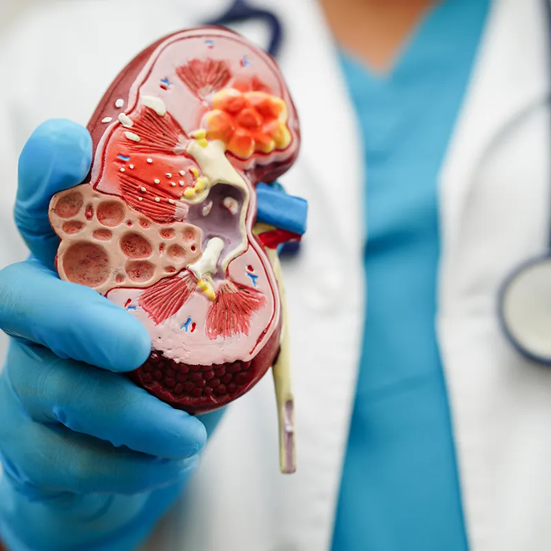 Kidney cysts